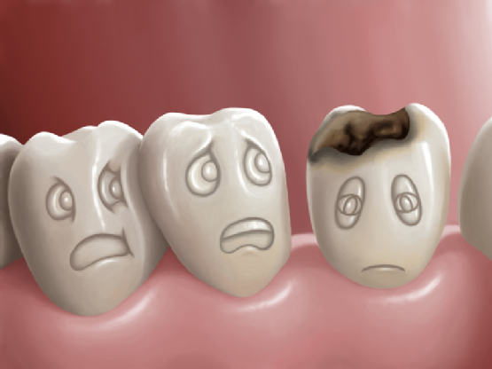 Có phải sâu răng là một bệnh lí răng không quan trọng?