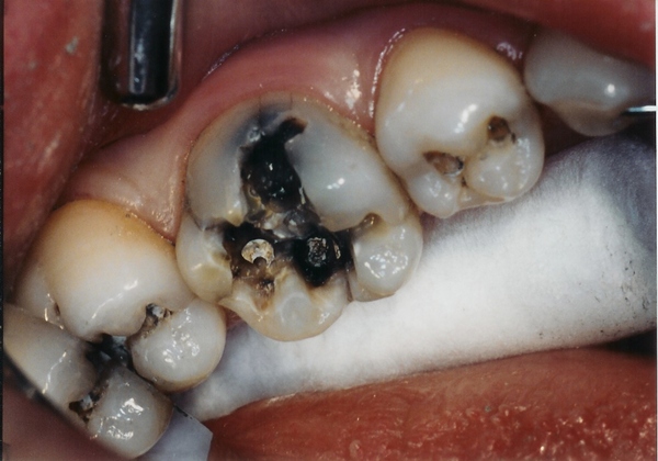 Kết quả hình ảnh cho răng sâu có nên nhổ không
