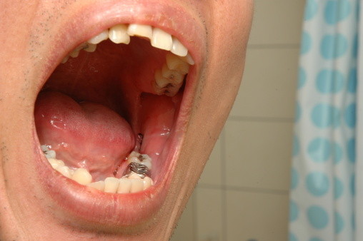 Nhổ răng số 8 có đau không?1