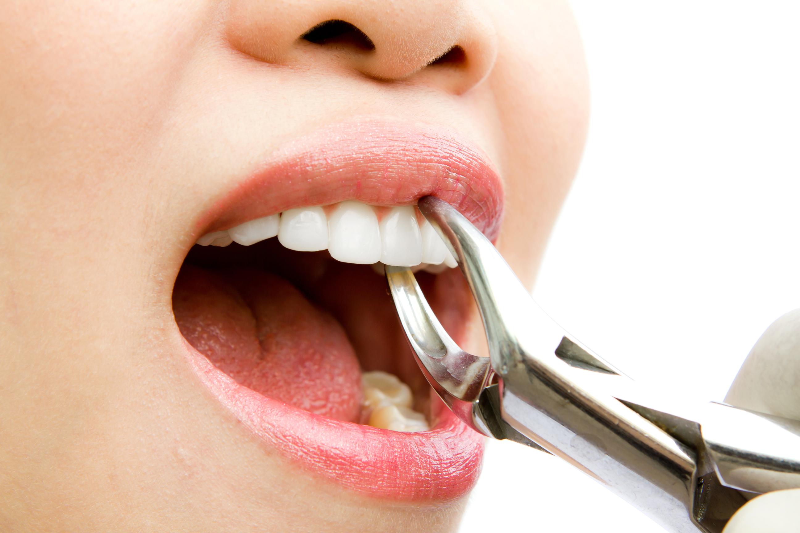 Nhổ răng cửa có đau không với công nghệ mới tại Nha Khoa KIM?
