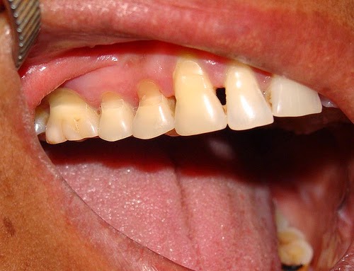 Nguyên nhân gây mất răng sớm và cách khắc phục hiệu quả nhất 1