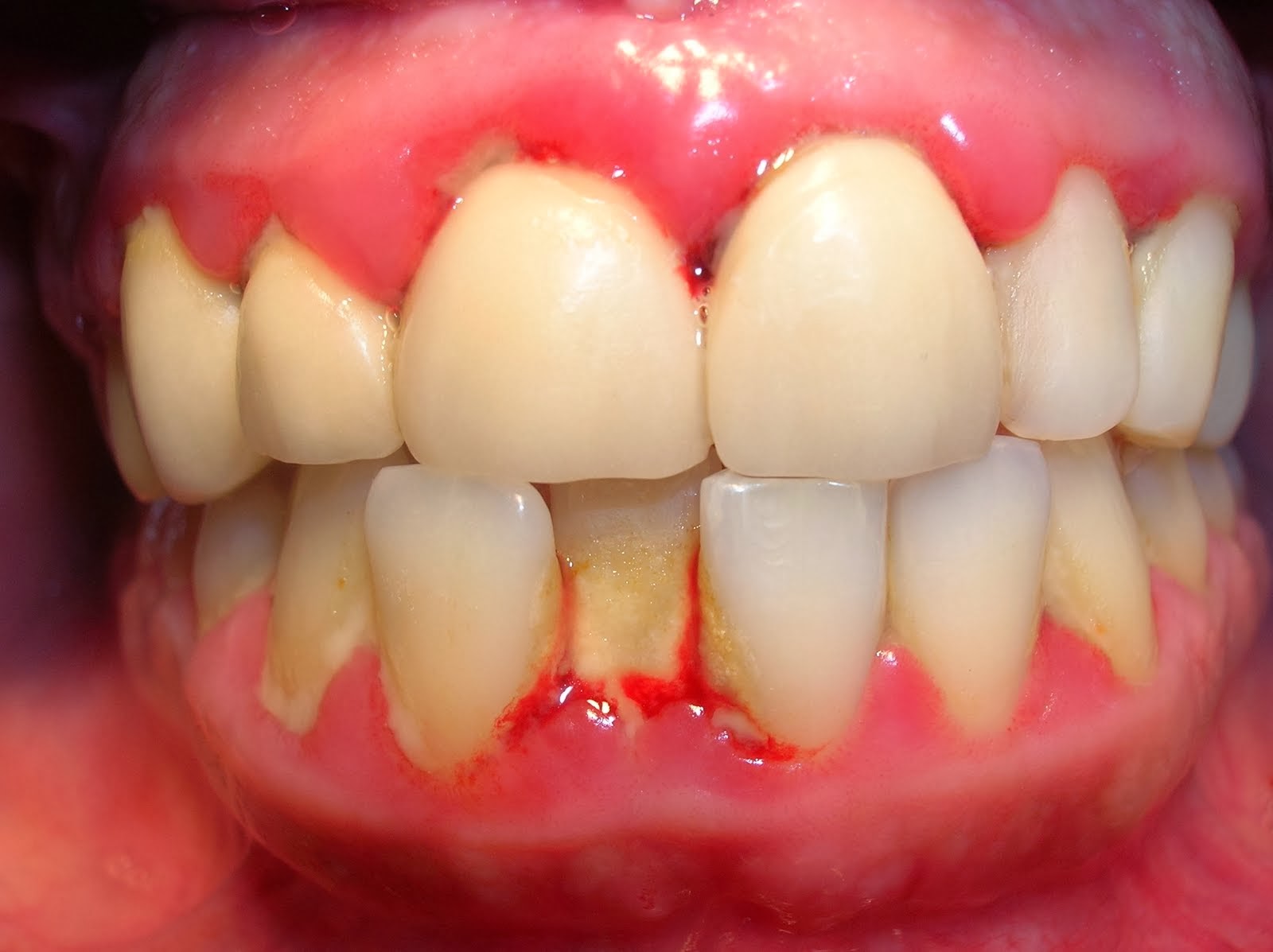 Nguyên nhân gây mất răng sớm và cách khắc phục hiệu quả nhất 2