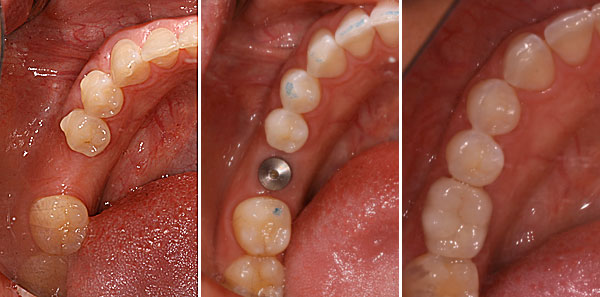 Nguyên nhân gây mất răng sớm và cách khắc phục hiệu quả nhất 3