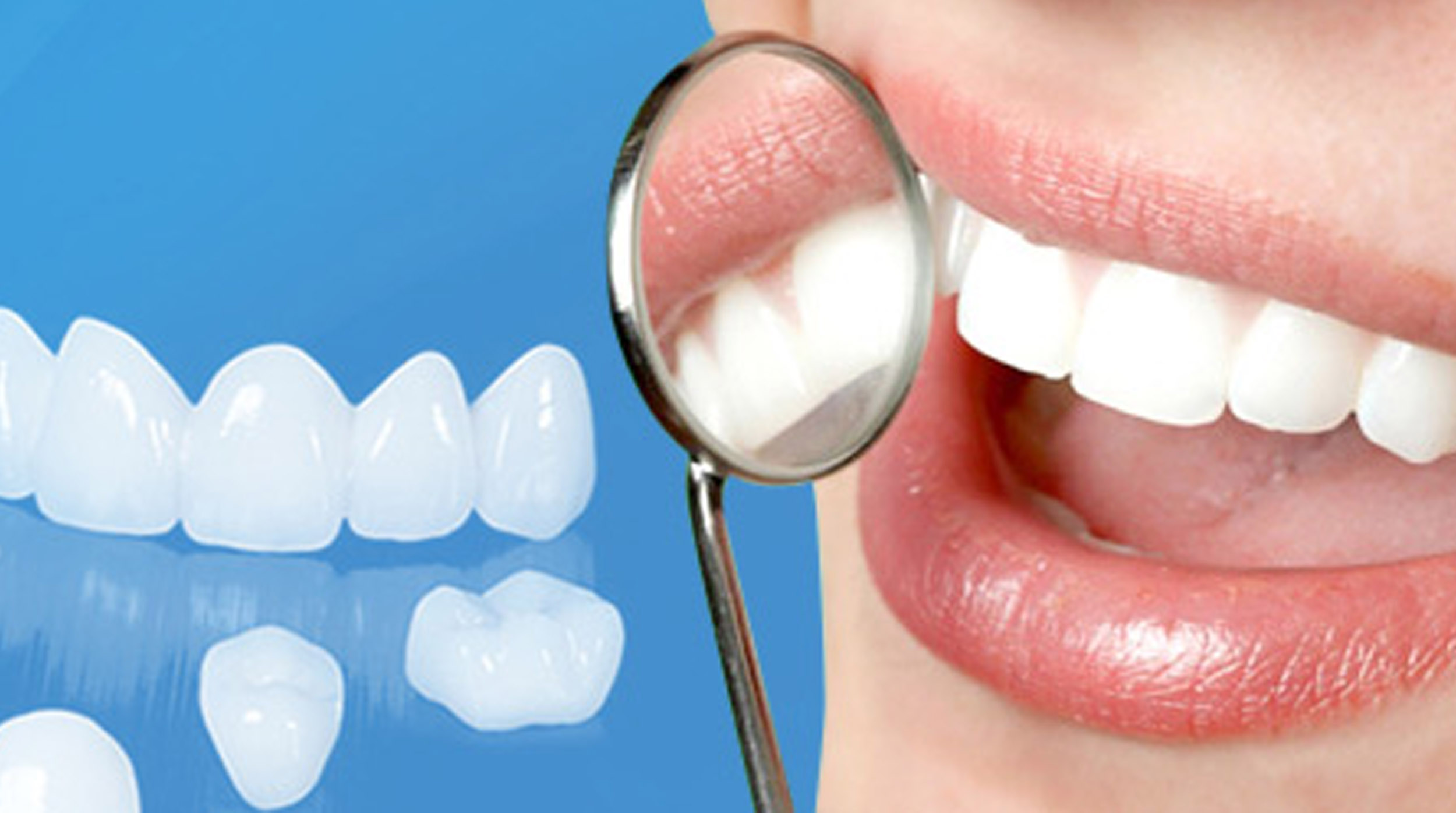 Những điều cần biết về Làm răng sứ Cercon 2