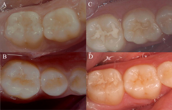 Bệnh sâu răng ở trẻ em và cách điều trị triệt để 2