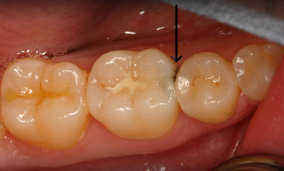 Bệnh sâu răng ở trẻ em và cách điều trị triệt để 1
