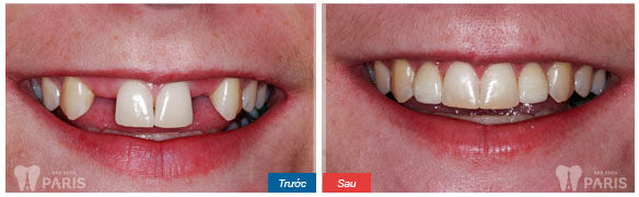 KH sử dụng dịch vụ cấy implant tại nha khoa Paris