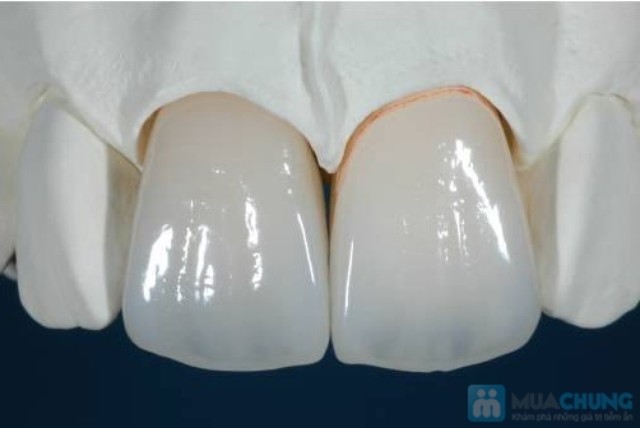 Nên lựa chọn răng sứ không kim loại Cercon để khắc phục răng xấu