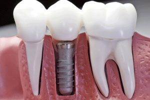 Cấy ghép răng implant có đau không , bao lâu thì lành? 1