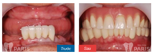  Hình ảnh KH thực hiện dịch vụ làm răng implant tại nha khoa Paris