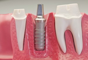 Bạn đã biết kỹ thuật cấy ghép implant là gì chưa? Bạn đã biết kỹ thuật cấy ghép implant là gì chưa?