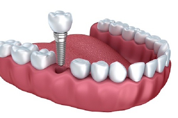 Cấy ghép răng implant có đau không?