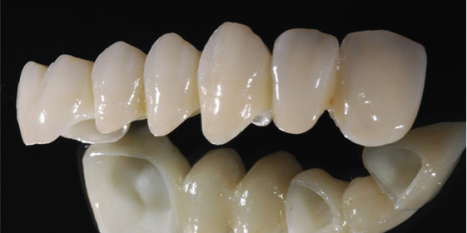 Răng Cercon là loại răng có tính thẩm mỹ cao và bên chắc 