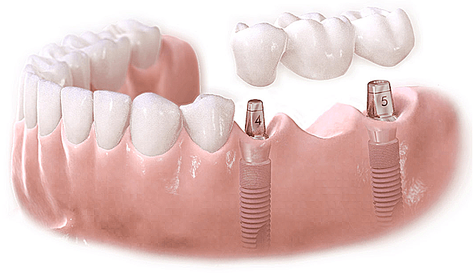 Hình ảnh khách hàng sử dụng dịch vụ cấy răng Implant