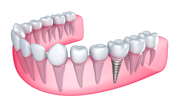 Cấy ghép răng implant là gì? 