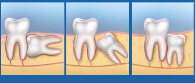 Răng khôn mọc lệch, mọc ngầm gây đau nhức thường được chỉ định nhổ bỏ