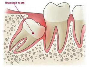 Giải đáp chi tiết 5 thắc mắc thường gặp về nhổ răng khôn 2