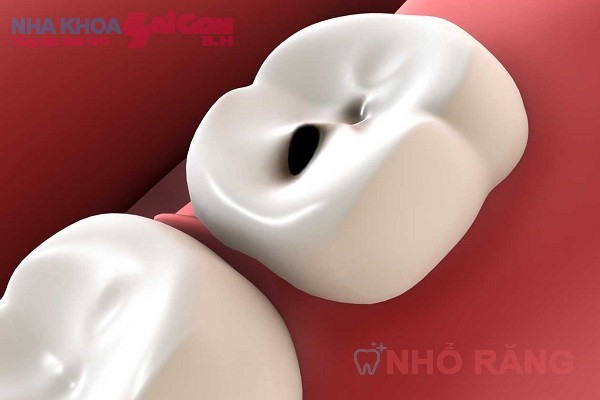 Sâu răng hàm ảnh hưởng khá lớn đến sức khỏe răng miệng