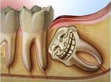 Mọc răng khôn hàm dưới có nguy hiểm không?
