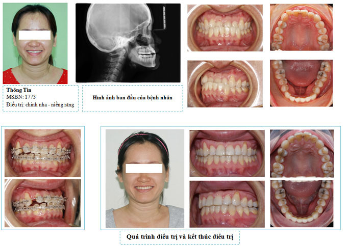 Hình ảnh KH thực hiện dịch vụ chỉnh răng vẩu tại nha khoa Pari