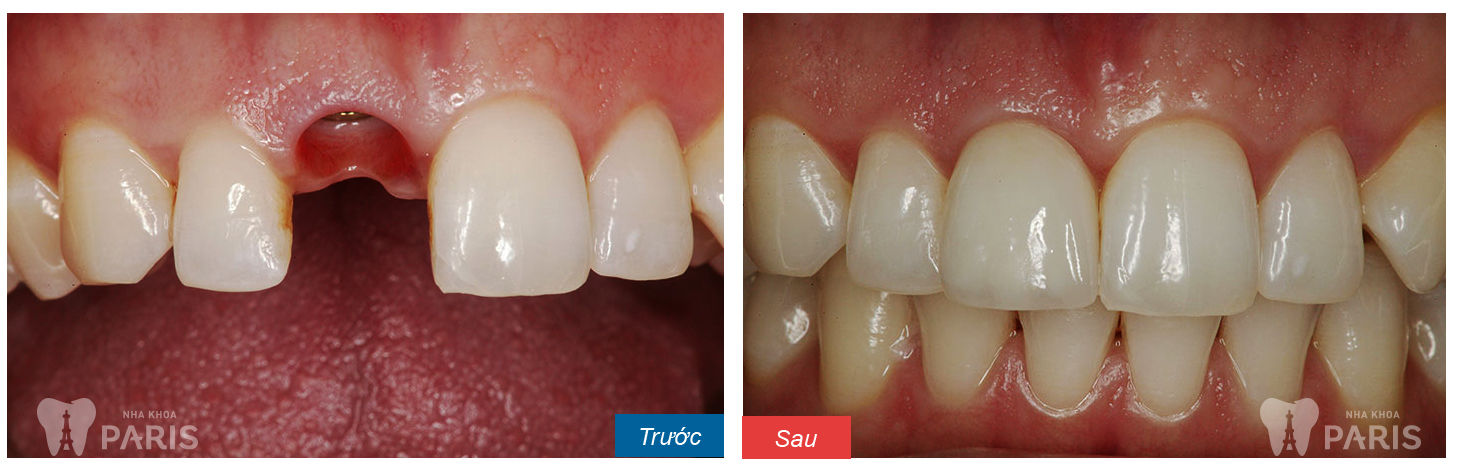 Hình ảnh KH sử dụng dịch vụ làm răng implant tại nha khoa Paris