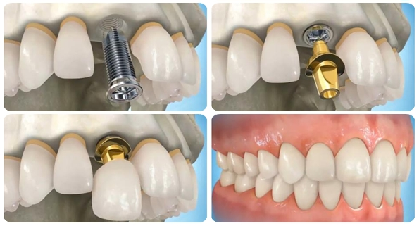Cấy ghép implant mất bao lâu sẽ phụ thuộc nhiều vào tình trạng răng mỗi người
