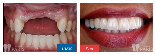 Trồng răng implant 4S tại nhà khoa Paris sẽ có kết quả chính xác và thẩm mỹ hơn. Hình ảnh KH thực hiện trồng răng tại NK Paris.