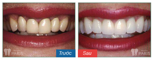 Hình ảnh khách hàng thực hiện chụp răng sứ tại Nha khoa Paris.