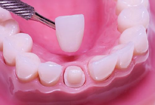 Bọc răng sứ có nguy hiểm - về bản chất là không gây hại gì cho răng