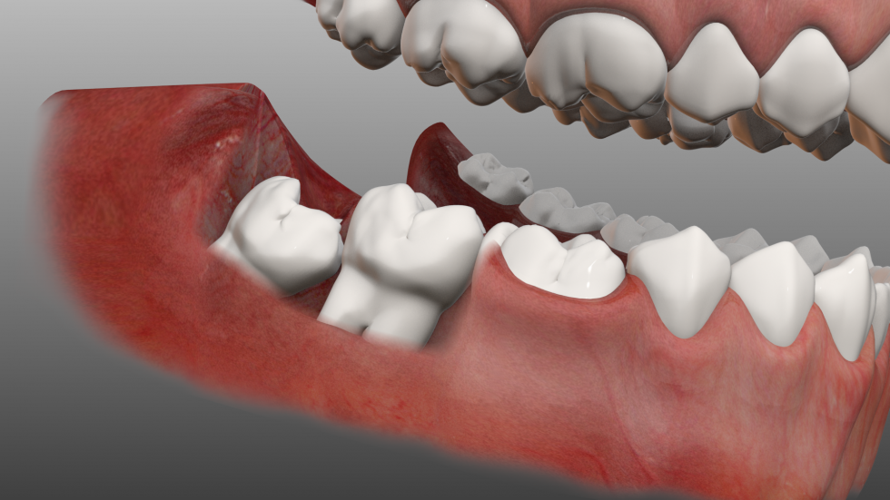 Răng hàm mọc lệch nên khắc phục bằng cách nào?