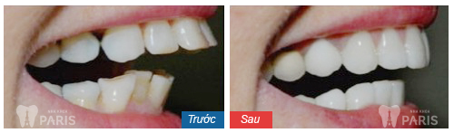 Chỉnh răng vẩu nhẹ sớm sẽ khiến bạn có hàm răng đều đẹp hơn.