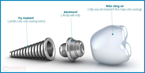 Cấu trúc răng Implant nha khoa gồm 3 phần chính 