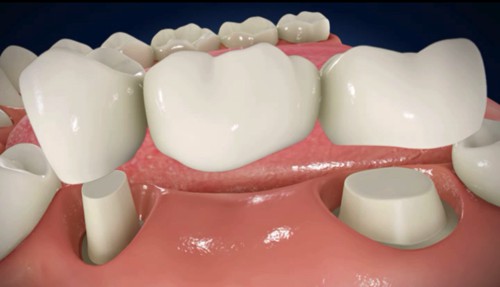 Trồng răng sứ như thế nào bằng phương pháp làm cầu răng