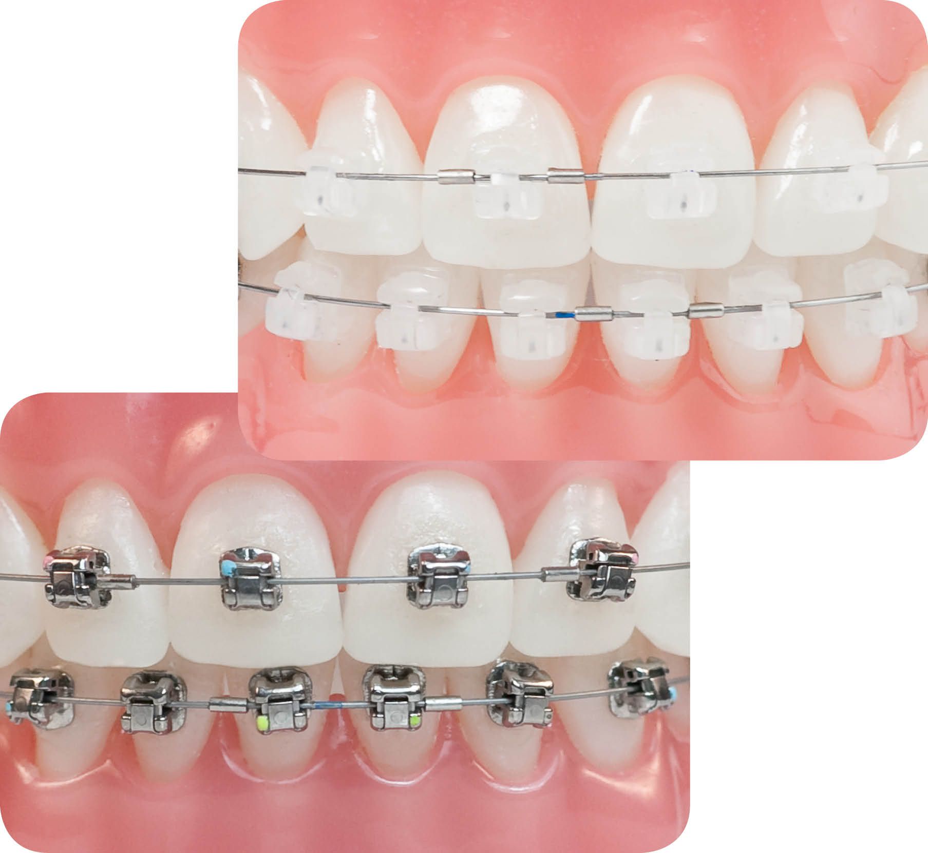 Niềng răng mắc cài 3M UGSL - giải pháp khắc phục răng hô toàn diện
