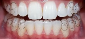 Làm răng thẩm mỹ Siêu Đẹp với CN Laser Whitening 2