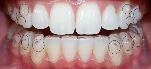 Niềng răng không mắc cài - Cách làm răng hết vổ hiệu quả