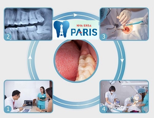 Quy trình nhổ răng không đau nhờ sự hỗ trợ của công nghệ gây tê tân tiến tại nha khoa Paris