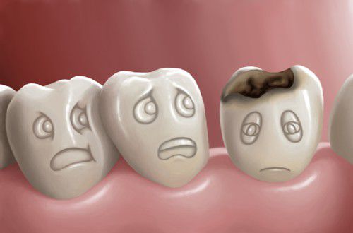 Răng hàm bị sâu có nên nhổ đi không là thắc mắc của rất nhiều người