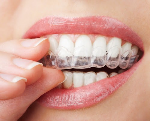 Quy trình tẩy trắng răng tại nhà bằng máng tẩy trắng răng