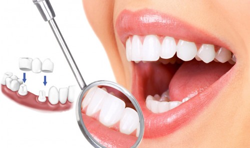 Trồng răng sứ có bị hôi miệng không cần phải xem xét trên nhiều nguyên nhân