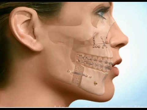 Vẩu do cấu trúc xương hàm cũng là một nguyên nhân phổ biến