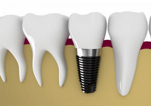 Khái niệm cấy ghép răng implant là gì? Ưu điểm Vượt trội 1