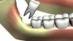 Tùy thuộc vào tình trạng của răng mà quyết định có nên nhổ răng khôn không