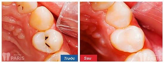 Răng vĩnh viễn bị sâu và 3 chỉ định điều trị trong nha khoa 2