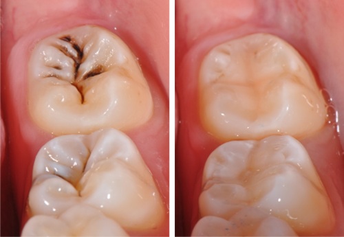 Răng vĩnh viễn bị sâu và 3 chỉ định điều trị trong nha khoa 1