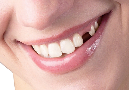 Giải đáp những điều hay thắc mắc về trồng răng thẩm mỹ 1