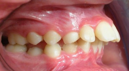 [Giải đáp] Loại bỏ hàm răng hô nhanh chóng, hiệu quả 100% 1