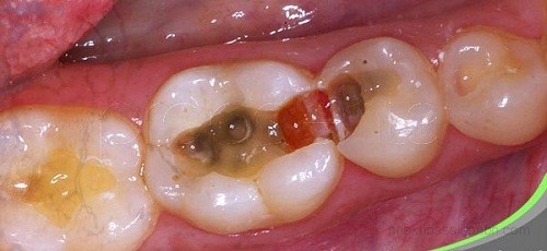 Sâu răng là gì? Ảnh hưởng của sâu răng như thế nào?