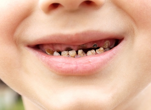 Nguyên nhân và cách chữa trị sâu răng ở trẻ em