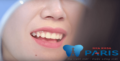 4 yếu tố giúp bạn xác định địa chỉ đính đá vào răng uy tín 1